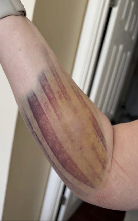 Bruised arm with visible linear marks extending from the elbow, showing significant, multi-colored bruising