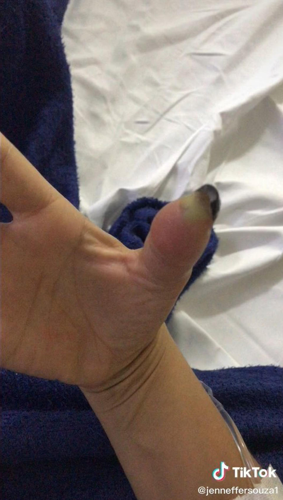 Jenneffer Souza shows her swollen and infected thumb in a TikTok video.