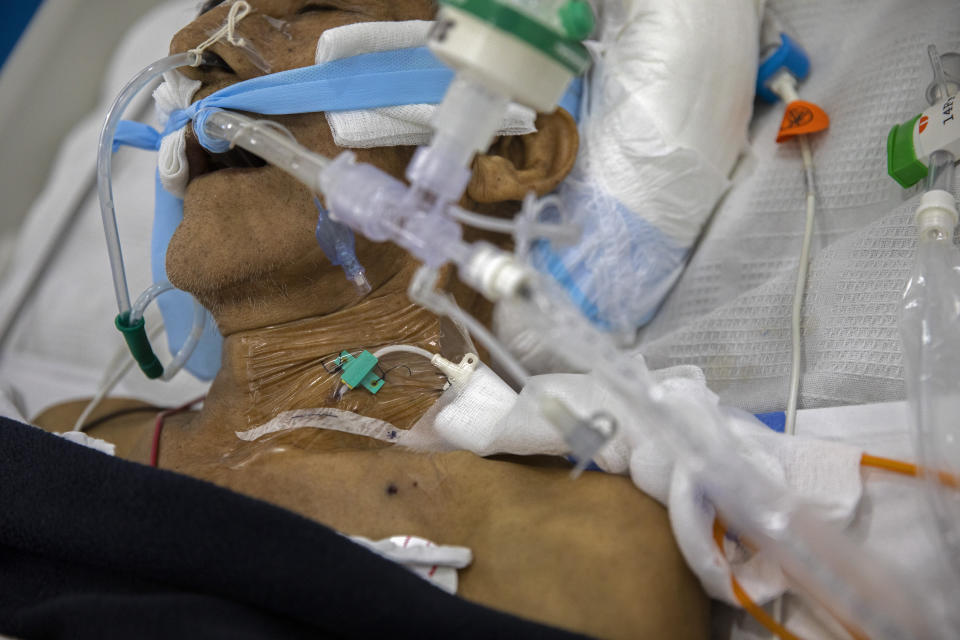 A COVID-19 patient is assisted by an artificial respirator in the intensive care unit of a public hospital in Pucallpa, in Peru's Ucayali region, Tuesday, Oct. 6, 2020. In the city of Pucallpa, doctors say they are beginning to encounter patients with the double diagnosis of COVID-19 and dengue. (AP Photo/Rodrigo Abd)