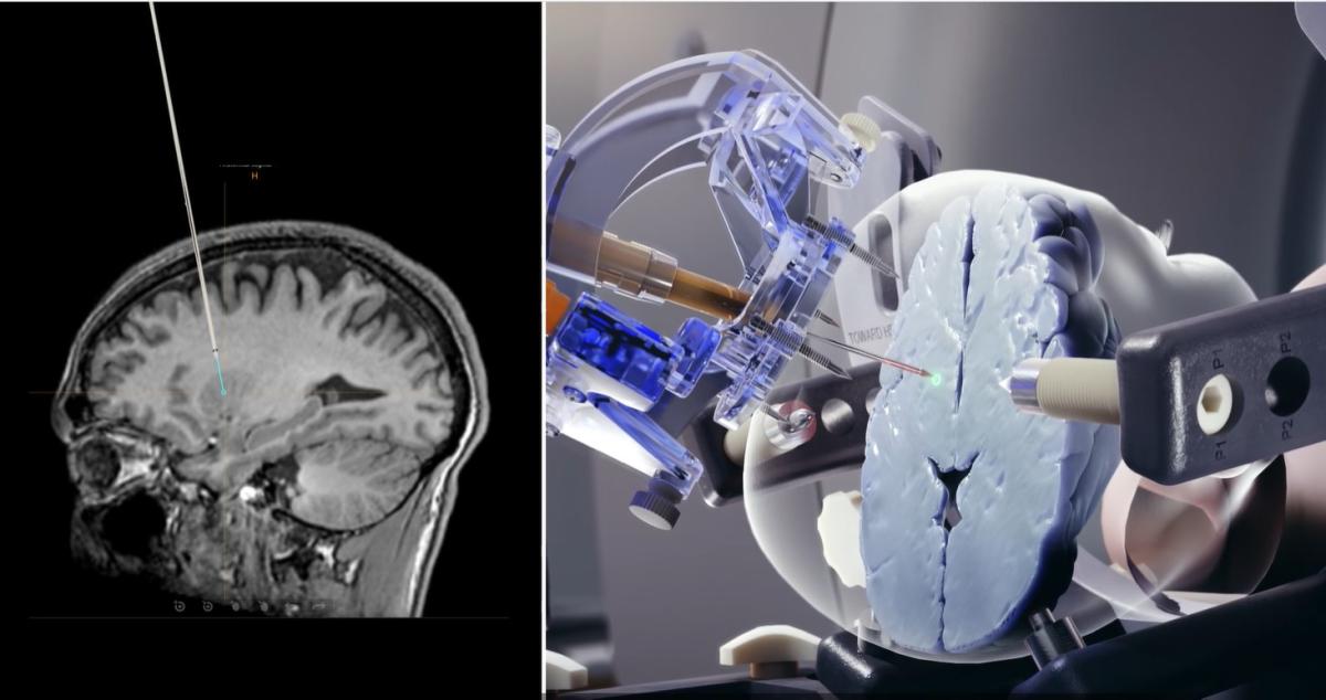 Using ClearPoint in Surgery for Patients with Brain Tumors, Dr