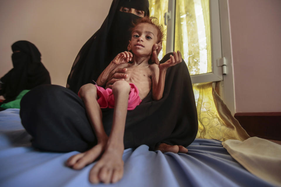 FILE - In this Oct. 1, 2018, file photo, a woman holds a malnourished boy at the Aslam Health Center, in Hajjah, Yemen. A leading aid organization on Monday warned that U.S. Secretary of State Mike Pompeo's move to designate Yemen’s Iran-backed Houthi rebels as a “foreign terrorist organization” would deal another “devastating blow" to the impoverished and war-torn nation. (AP Photo/Hani Mohammed, File)