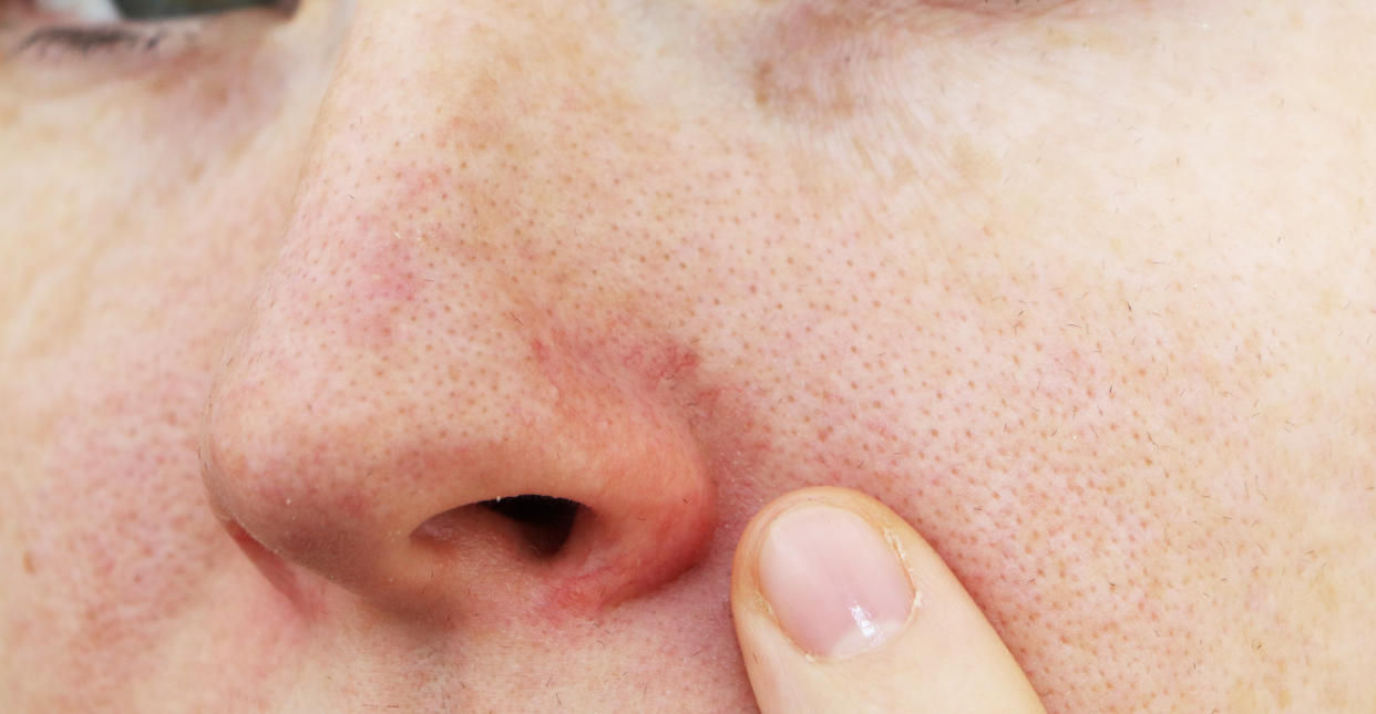 Algunas personas tienen manchas rojas en la nariz y se le notan los capilares de las aletas. Esas venitas rojas son una manifestación cutánea que responde a una anomalía de la función del sistema venoso facial. (Foto: Getty)