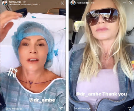 Tamra Judge Surgery 1