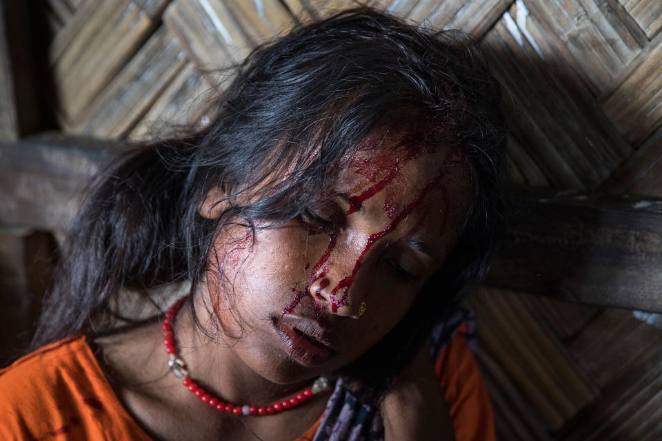 <p>Aneta Begum, 25, waits for treatment for a head injury in the emergency unit at the ‘Doctors Without Borders’ Kutupalong clinic on October 4, 2017 in Cox’s Bazar, Bangladesh. (Photograph by Paula Bronstein/Getty Images) </p>