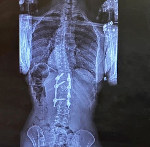 <p>Courtesy Amanza Smith</p> X-ray image showing the titanium rods inserted in Smith's spine.