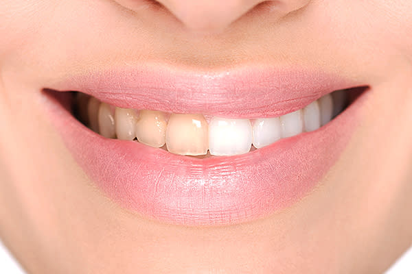 Una mala higiene dental puede provocar decoloración dental. Foto: svetikd / Getty Images.