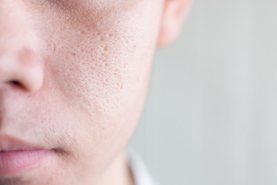 如果是超過35歲女性想要對抗「衰老型毛孔」，一定要做到嚴格防曬對抗光老化以及使用含有A醇成分的產品，因為維生素A成分能促進皮膚膠原蛋白生成。建議熟齡肌膚需要用比較滋潤的霜來幫皮膚鎖水。否則皮膚一但乾燥缺水就會導致毛孔變成橢圓形，通常還會伴隨著皺紋、細紋增多等情況。