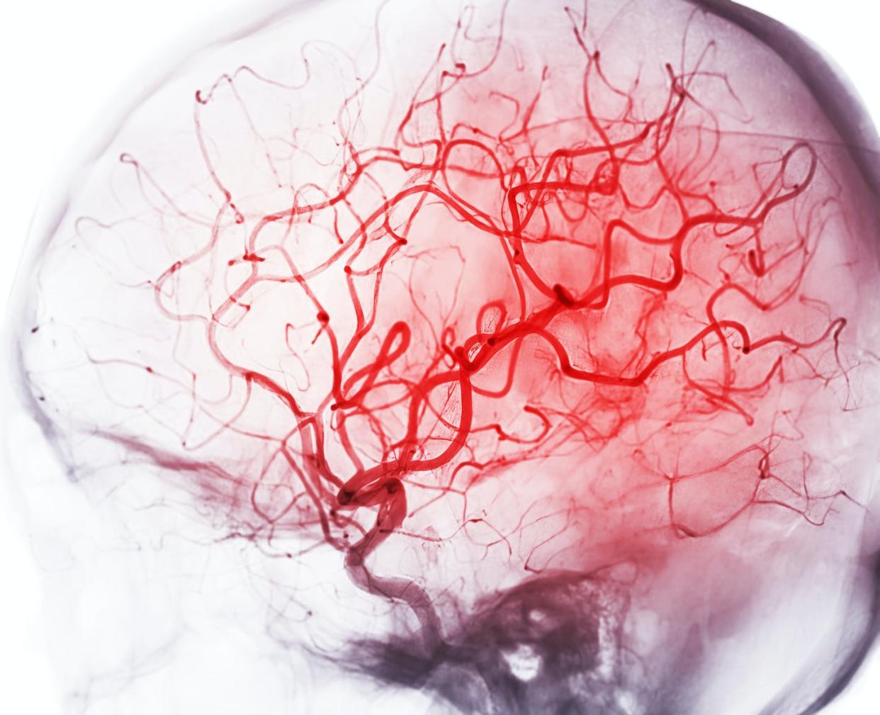 Blood carries oxygen and vital nutrients to the brain. <a href="https://www.gettyimages.com/detail/photo/cerebral-angiography-image-from-fluoroscopy-in-royalty-free-image/1473413961" rel="nofollow noopener" target="_blank" data-ylk="slk:Mr. Suphachai Praserdumrongchai/iStock via Getty Images;elm:context_link;itc:0;sec:content-canvas" class="link ">Mr. Suphachai Praserdumrongchai/iStock via Getty Images</a>