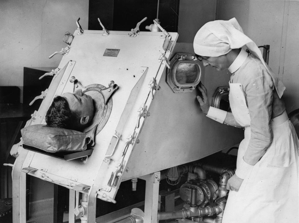 An iron lung at St. Bartholomews Hospital. London. About 1935. | Getty Images