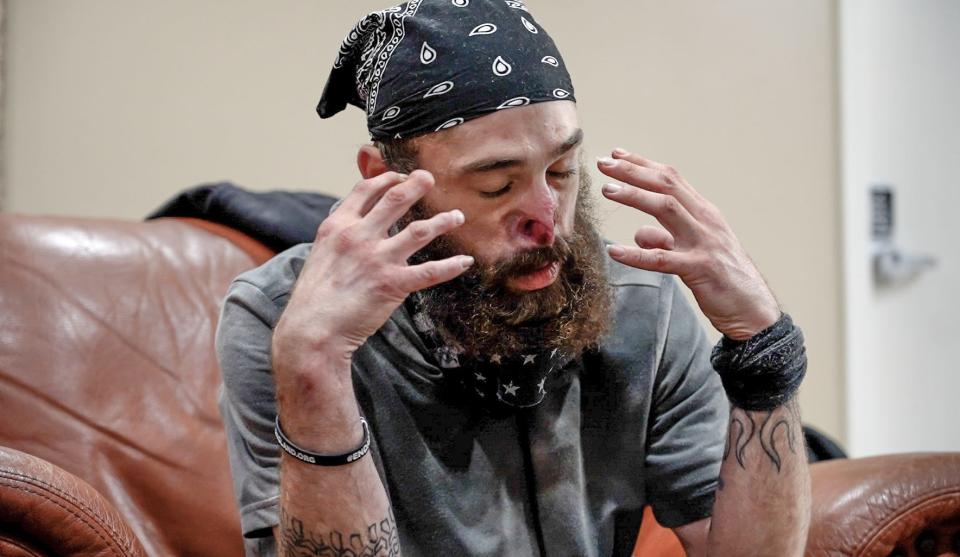 Ryan Yergeau has a rare skin condition, prurigo nodularis, that has eroded much of his nose. Homelessness has complicated his efforts to find treatment.