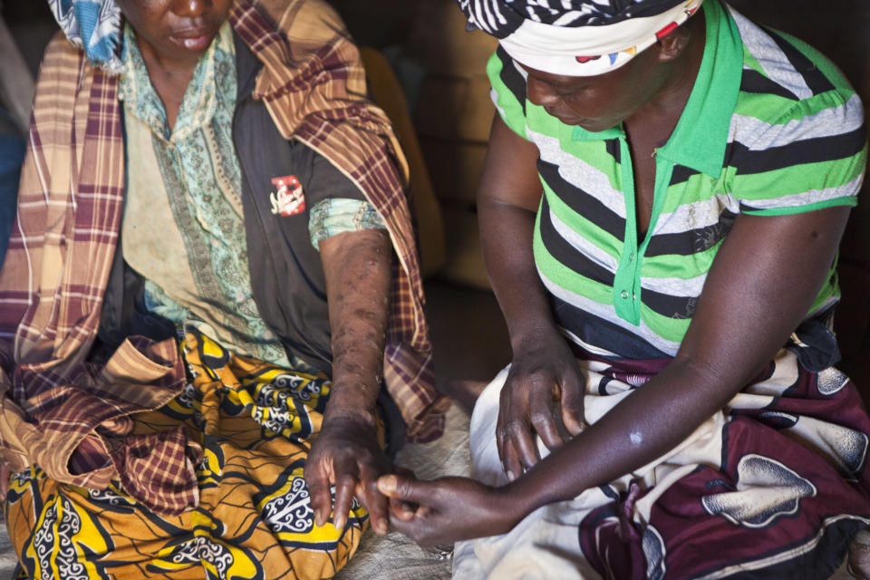 An African woman shows her skin condition to her visiting friend and caregiver in a small village in Mozambique, August 2012. The caregiver works for a charity that aims to increase HIV awareness and to support people affected by the disease and poverty. (Photo: In Pictures Ltd./Corbis via Getty Images)