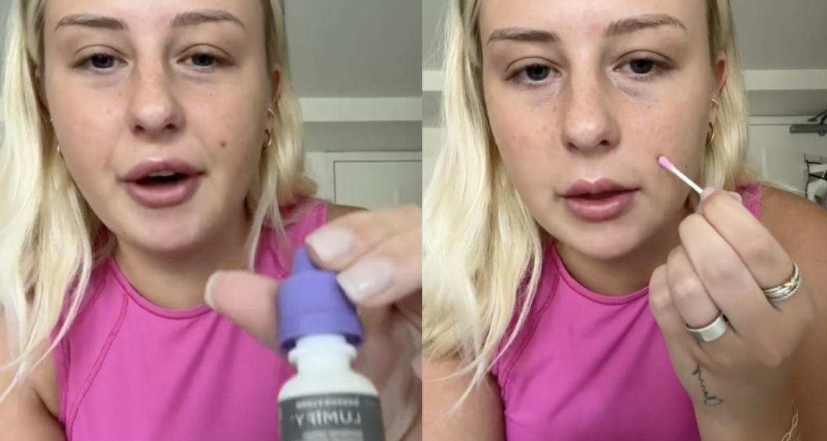 People on Social Media Are Using Eye Drops to Conceal Acne Redness