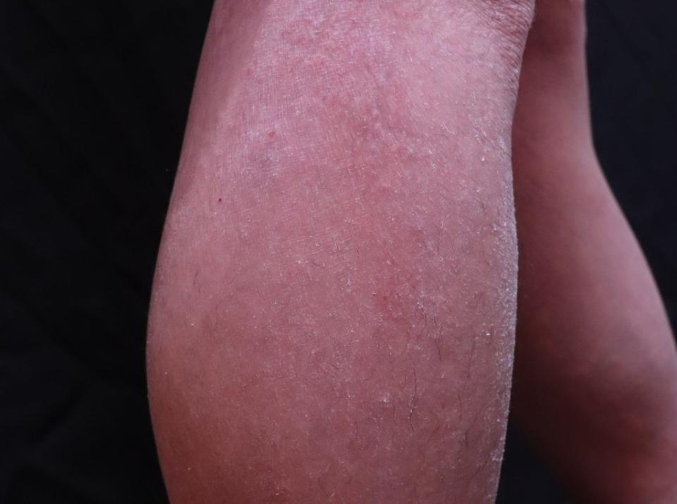 冬季癢患者症狀明顯，皮膚出現乾燥、搔癢、皮屑，甚至出現龜裂。 (花蓮慈濟醫院提供)