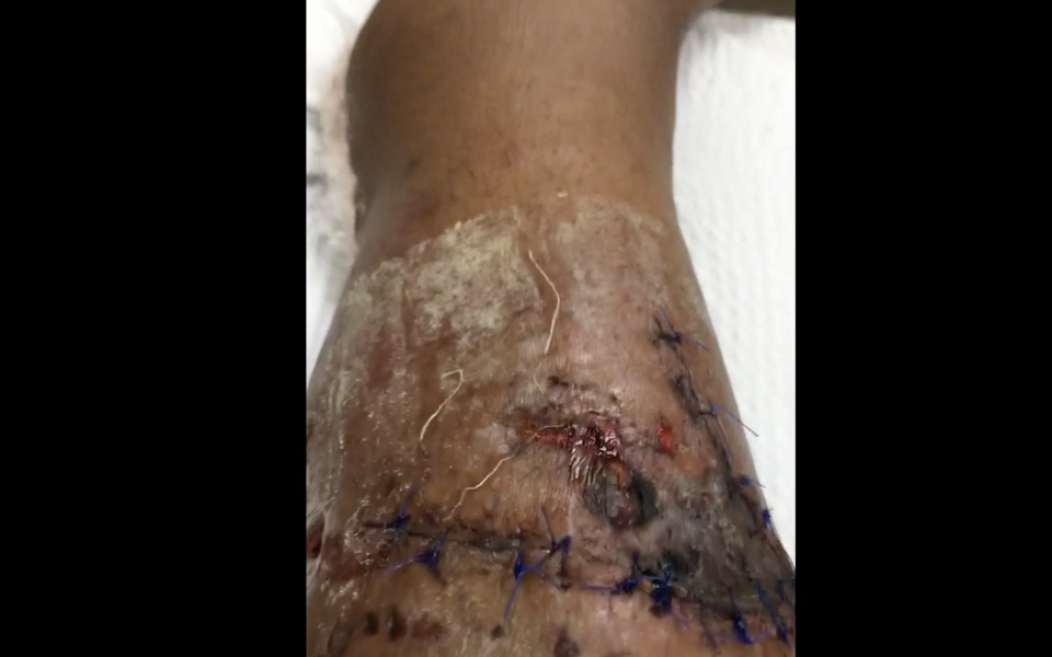 A photograph of Ryans' leg after the attack. / Credit: CBS News