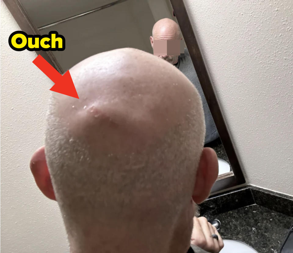 A giant bump on a man's head