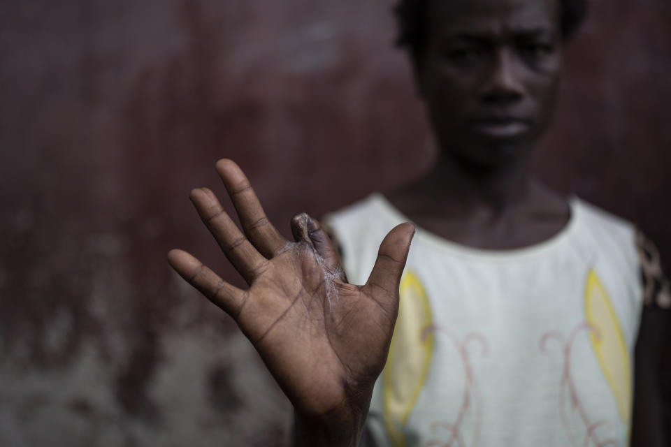 FILE - Lenlen Desir Fondala shows her hand that is missing a finger shot off by a stray bullet during a gang attack while she was living in Cite Soleil, as she stands in Jean-Kere Almicar's front yard where she is seeking refuge, in Port-au-Prince, Haiti, June 4, 2023. (AP Photo/Ariana Cubillos, File)