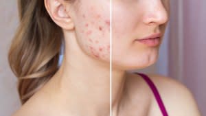 Acne-Before-After-Stock-Photo