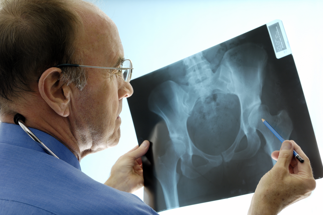 Doctor examining a pelvis x-ray