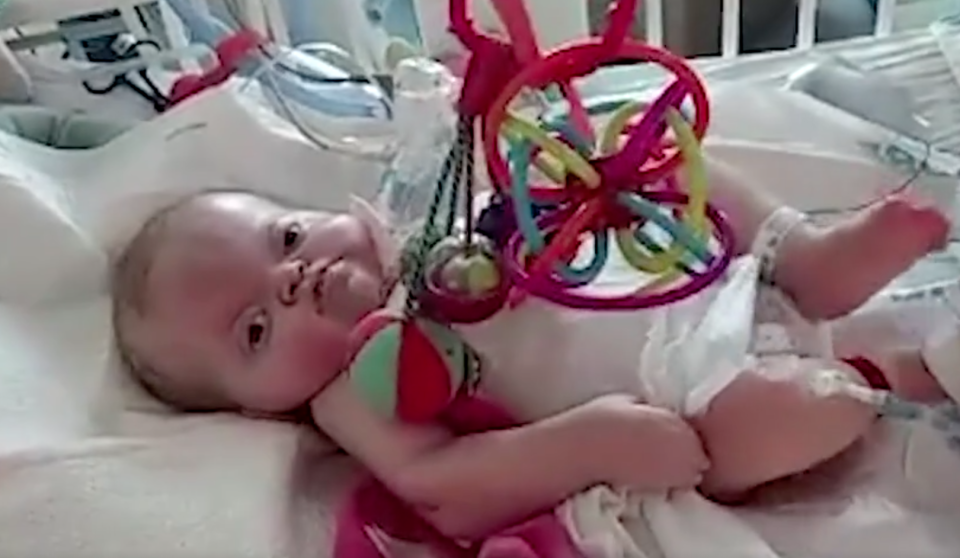 Gracie lives with Apert syndrome, a genetic disorder that causes a fusion of bones in the skull and spine. Photo: SWNS