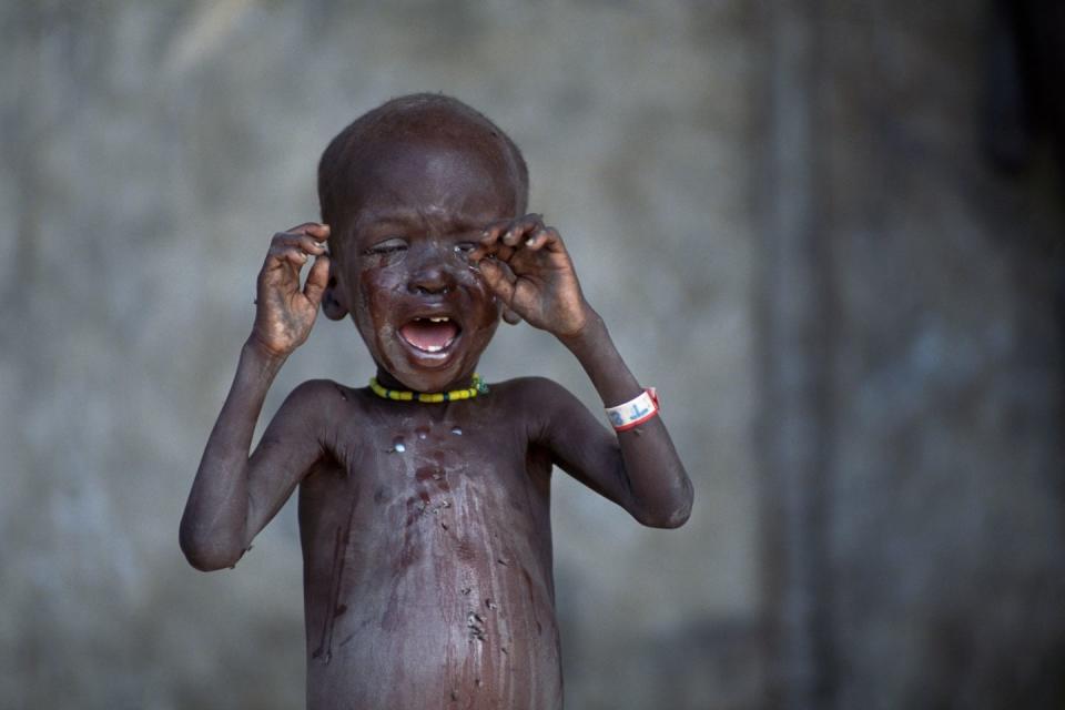 <p>A child famine victim in a feeding center.</p><p><strong>RELATED: </strong><a href="https://www.redbookmag.com/life/friends-family/news/a49413/teacher-stocks-class-cabinet-food/" rel="nofollow noopener" target="_blank" data-ylk="slk:Amazing Teacher Keeps Her Classroom Cabinet Full of Food for Hungry Students;elm:context_link;itc:0;sec:content-canvas" class="link "><strong>Amazing Teacher Keeps Her Classroom Cabinet Full of Food for Hungry Students</strong></a></p>