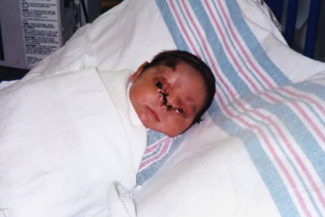 <p>Courtesy Canales Family</p> Gray Canales at 4 weeks old, after surgery to graft skin where his nose should have been.