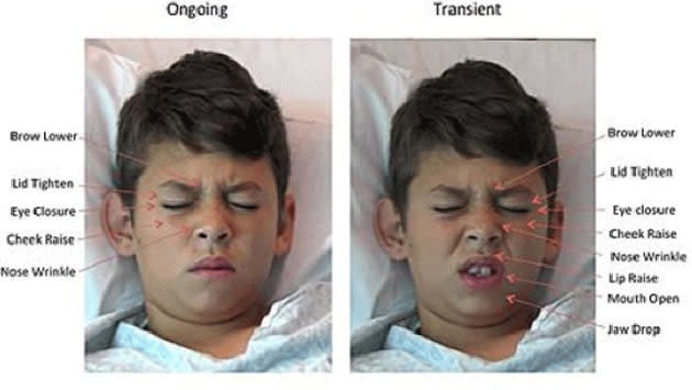 UC San Diego's computer vision pain algorithm