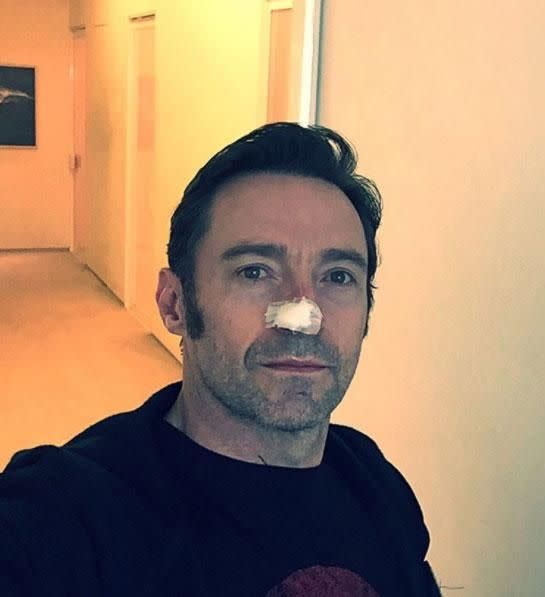 Back in February, Hugh shared a photo of himself with a bandage plastered across his nose. That was the sixth time the father-of-two had treatment for the cancerous cell. Source: Instagram