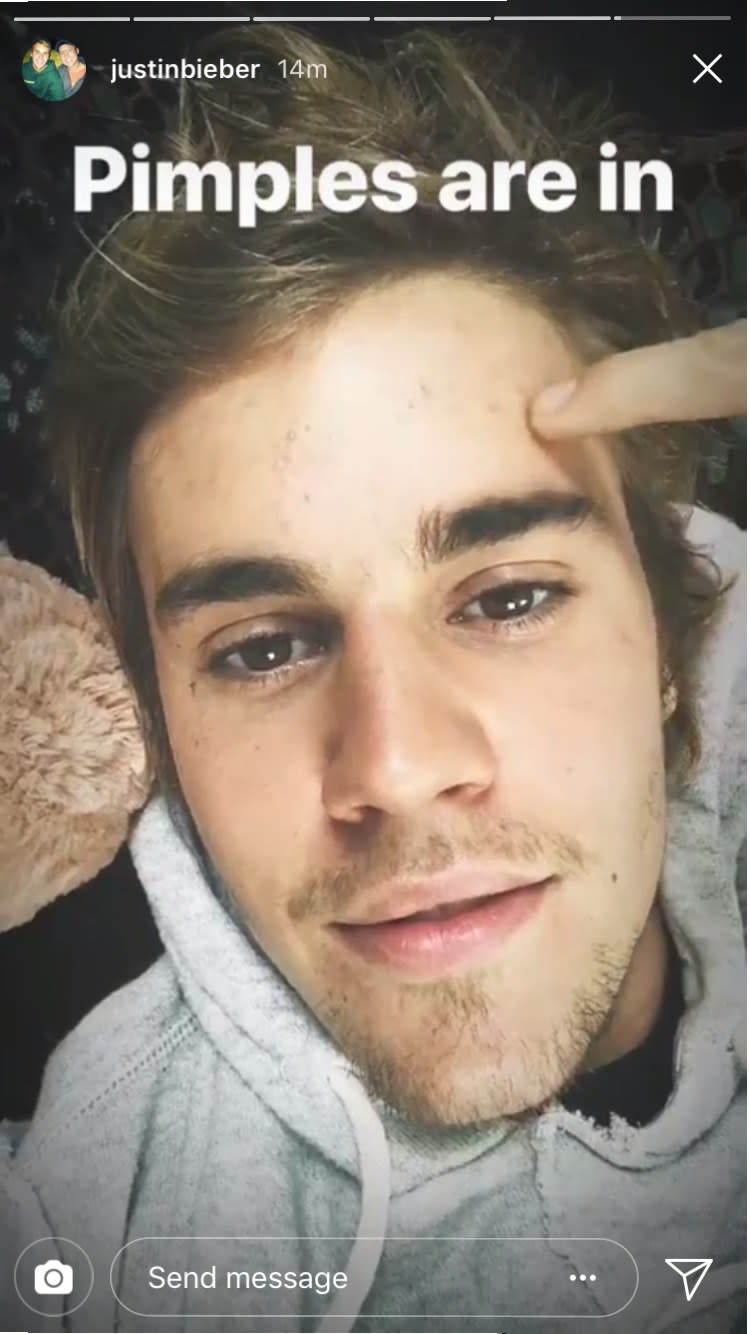 Hasta <span>Justin Bieber se hizo zoom sobre su acné, convirtiéndolo en su publicación más accesible hasta ahora (Foto: <span> Instagram/Allure)</span></span>