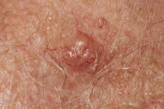 <p>Science Photo Library / Getty Images</p> Basal cell carcinoma