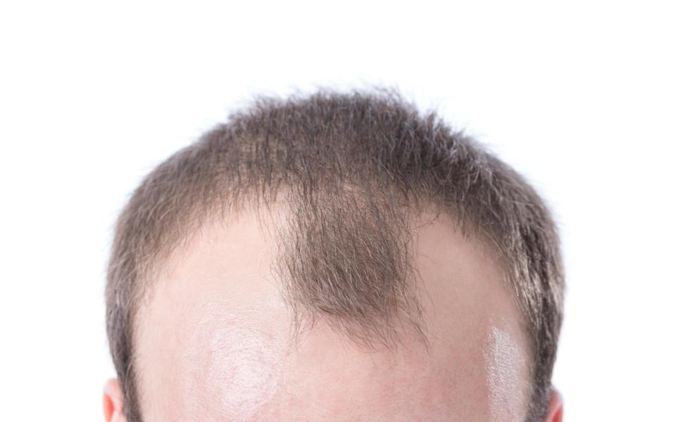 researchers discover the cells which hold the clue to overcoming hair loss - www.alamy.com