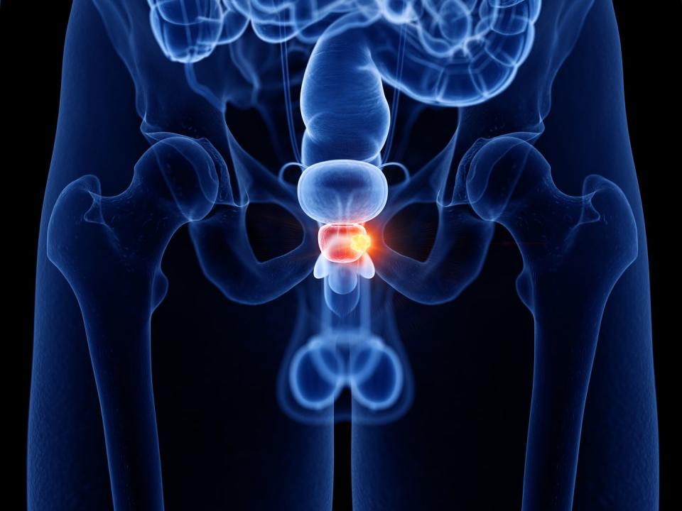 prostate cancer, computer illustration