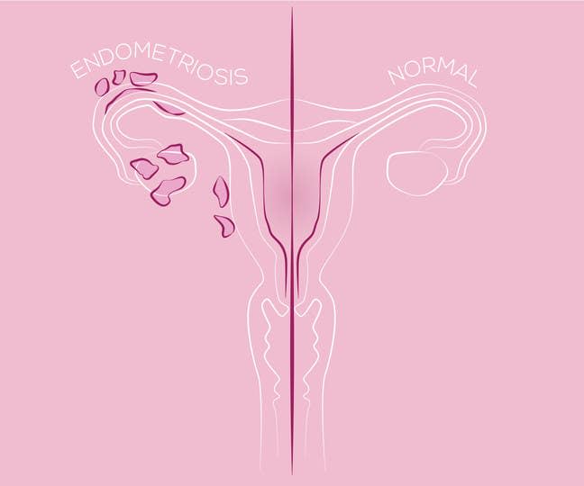 A diagram showing a normal uterus compared to a uterus with endometriosis