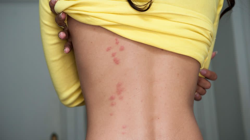 Bedbug bites are visible on the back of a woman standing in a hotel room. - Joel Carillet/iStockphoto/Getty Images