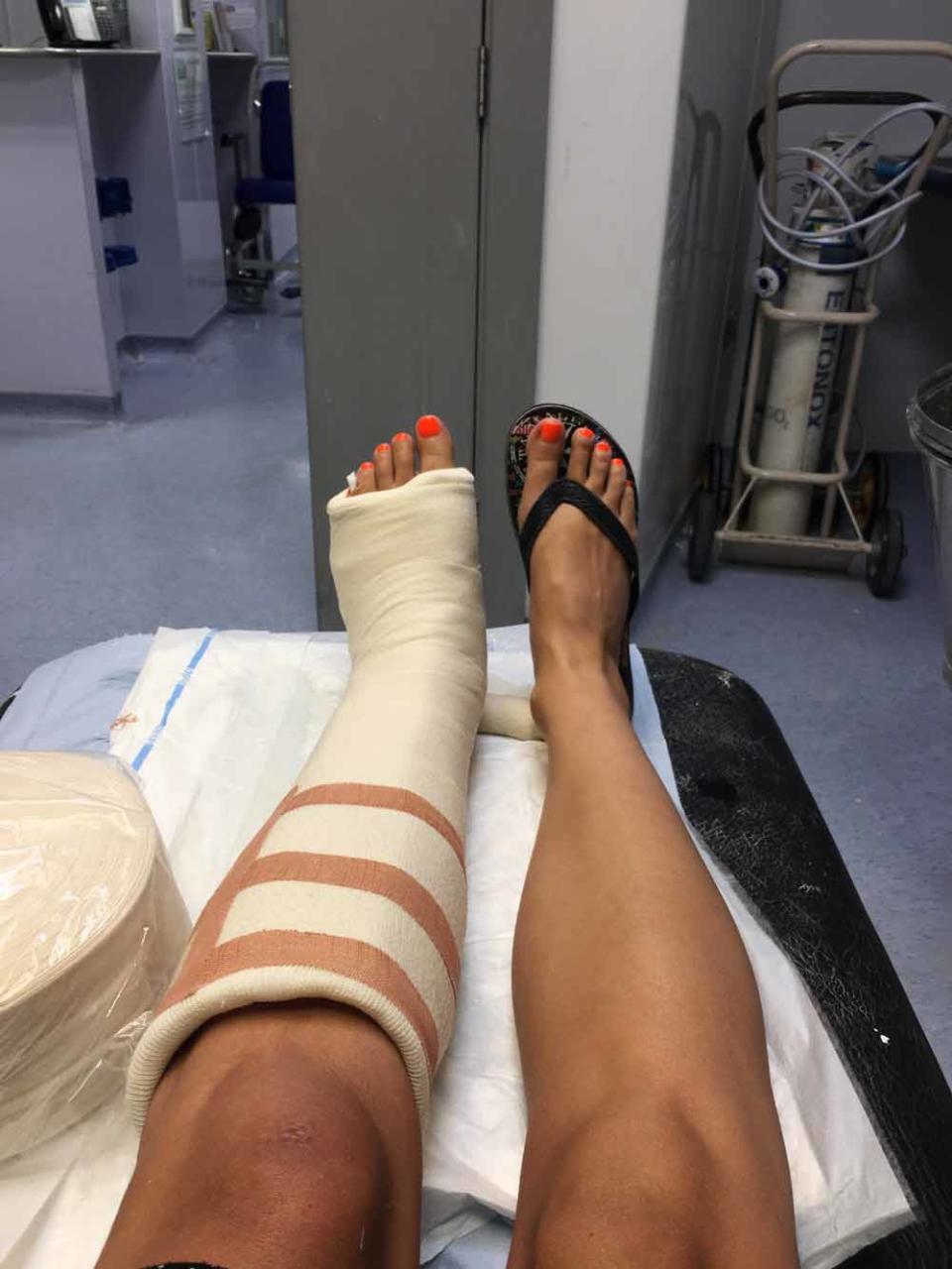 Charlotte stubbed her tow which caused a fracture of the fifth metatarsal in July 2016 (Collect/PA Real Life). 