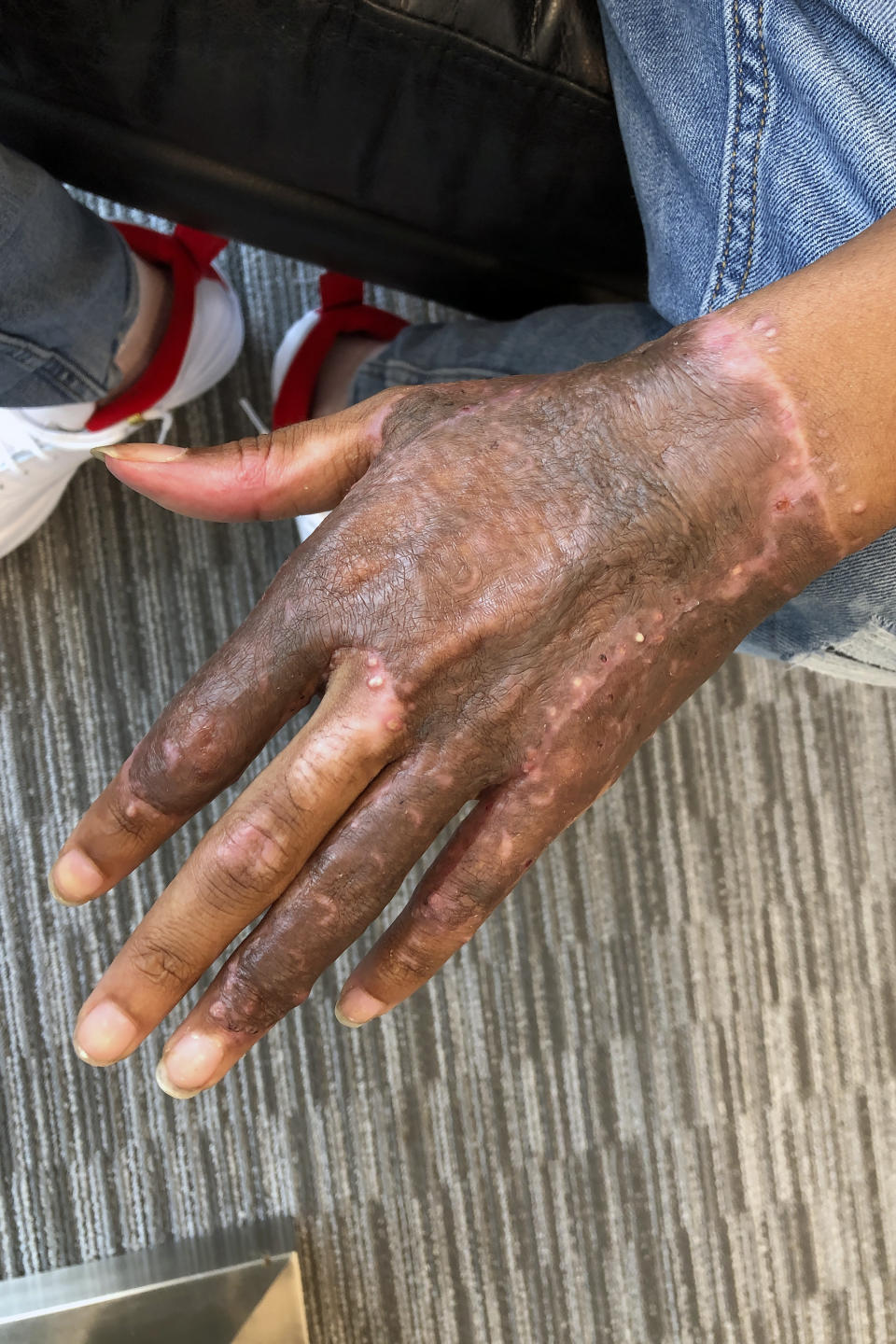 In this Sept. 12, 2019 photo, Malachi McFadden, 16, who suffered serious burns during a chemistry class demonstration on Aug. 6, poses for a photo at his lawyer's office, in Atlanta. Lawyers for McFadden, a student who was burned during a chemistry class demonstration have released a report, Wednesday, Nov. 6, 2019, saying his teacher violated school district standards. (AP Photo/Kate Brumback)