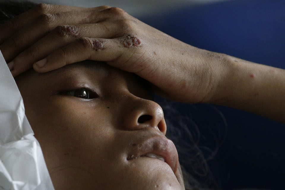 Anisa Cornelia lies inside a medical tent after being injured in a massive earthquake and tsunami in Palu, Central Sulawesi, Indonesia Thursday, Oct. 4, 2018. All she could think of was the love of her life, the man she was supposed to marry this month. She had not seen him since a deadly tsunami smashed into the Indonesian city of Palu last week, separating the pair possibly forever as they strolled along a sandy beach at twilight. (AP Photo/Aaron Favila)