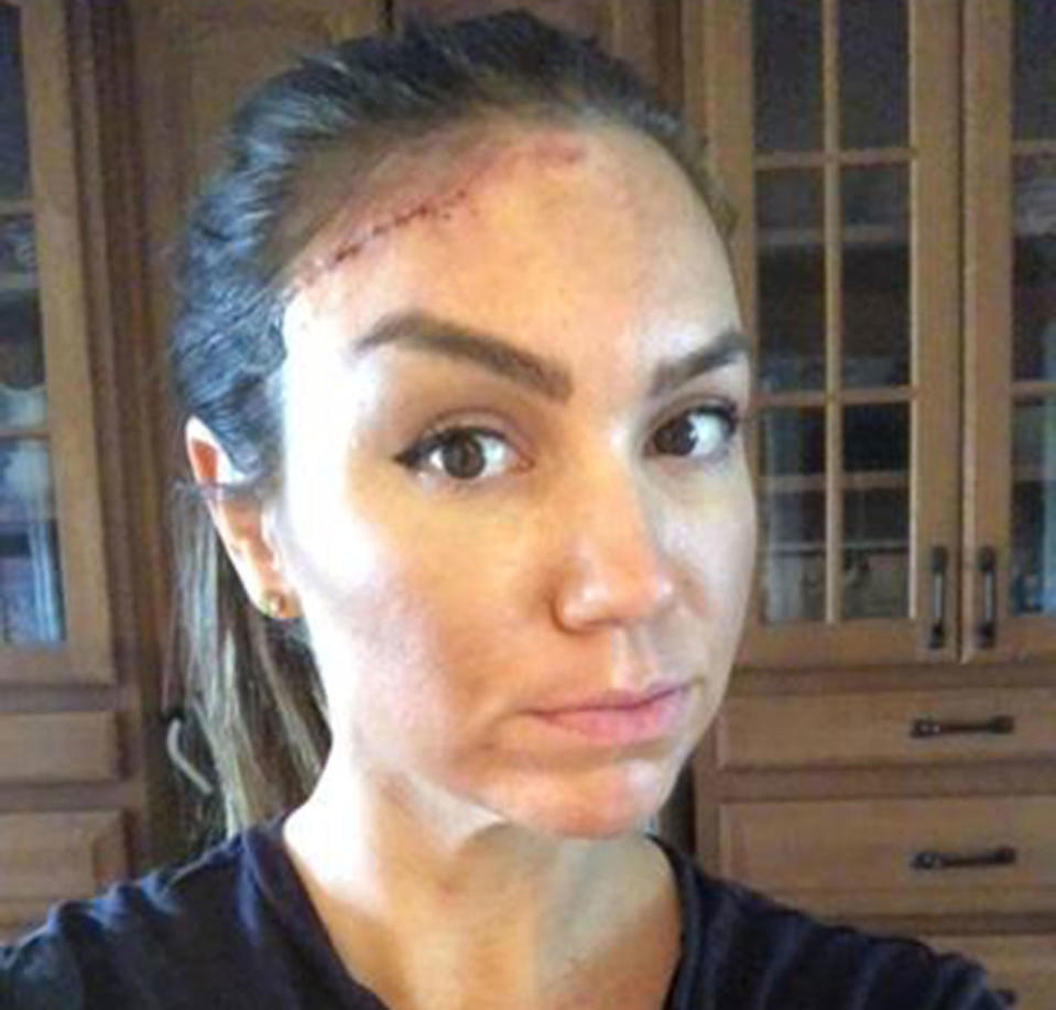 Keri Noble with a scar in her forehead after she had a basal cell carcinoma removed which is a form of skin cancer. She believes she got the cancerous cells from sun exposure and tanning beds.