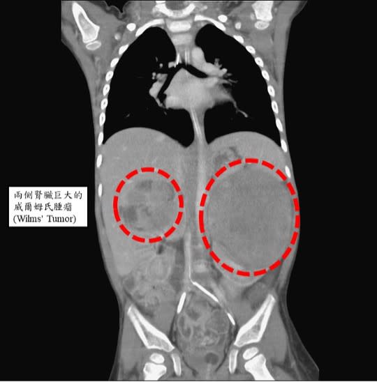 吳小妹妹2歲半時發現兩側腎臟巨大的威爾姆氏腫瘤，必須切除雙側腎臟，再接受化學治療。圖／台北榮總提供