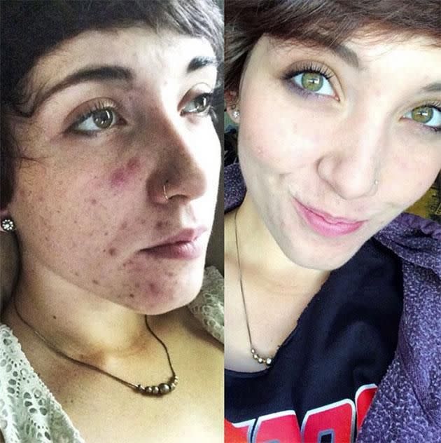 @aneotername Before and after using Frank original scrub. Photo: Instagram