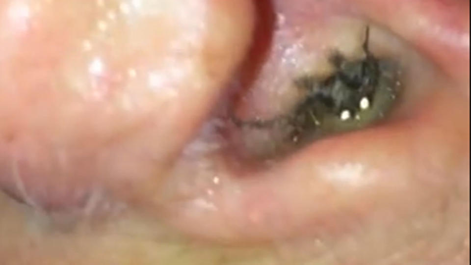 This spider in the ear video, which has gone viral, is the latest one to be revealed as a fake. Photo: Youtube