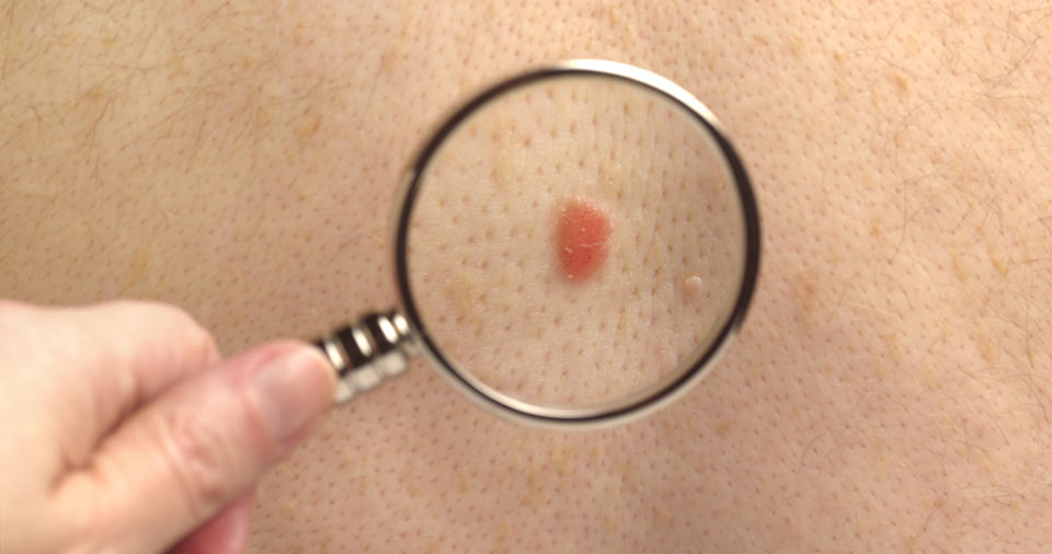 doctor looking at skin cancer melanoma