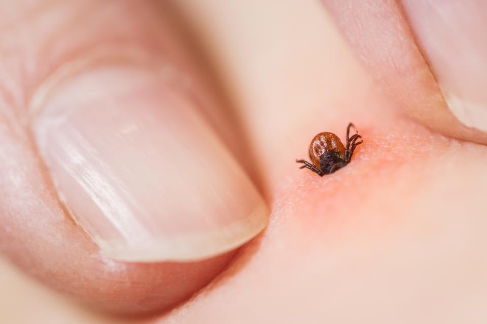 A close-up of a tick attached to a person's body.  Fingers touch the skin on both sides of the tick.