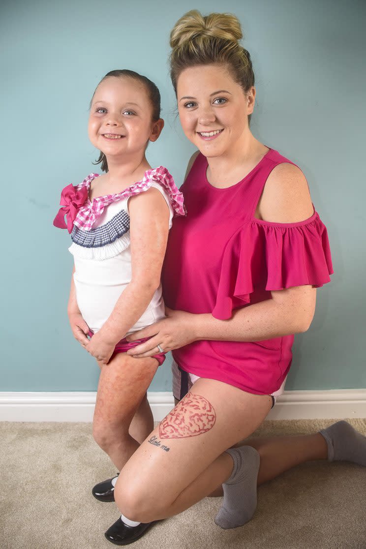 Kory Poxton got a tattoo that looks like her daughter Tarly’s rare skin condition. (Photo: Caters News)