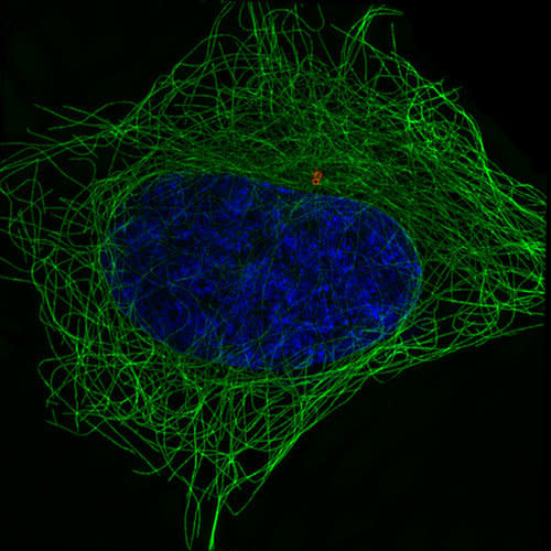 Cancerous cervical cell in interphase, another stage of cell division.  DNA pictured in blue. 