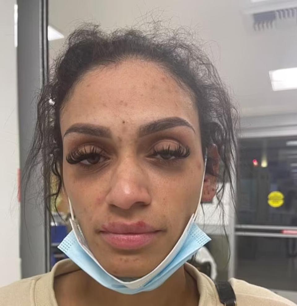 Mychelle Johnson posted images of her injuries on social media (Mychelle Johnson / Instagram)