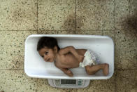 A malnourished baby is weighed at the Indira Gandhi hospital in Kabul, Afghanistan, Sunday, May 22, 2022. Some 1.1 million Afghan children under the age of five will face malnutrition by the end of the year. , as hospitals wards are already packed with sick children . (AP Photo/Ebrahim Noroozi)
