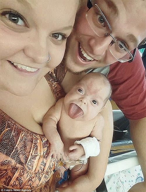 Baby Paisley was born with an oversized tongue, as a result of Beckwith Wiedemann Syndrome. Photo: Supplied