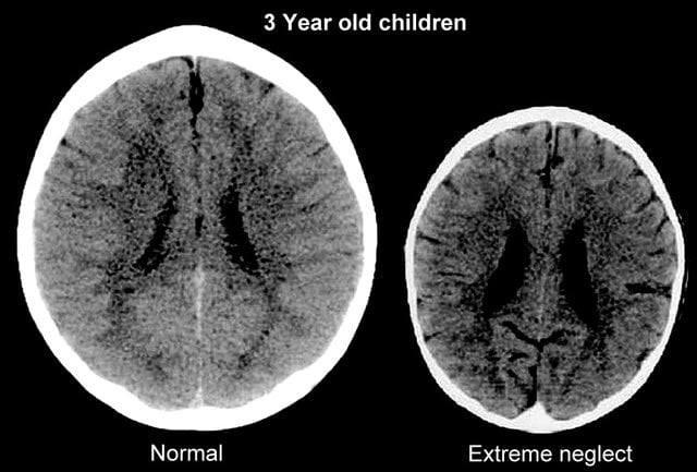 3歲孩子的腦，萎縮得像八十歲的老人。（示意圖／ResearchGate）
