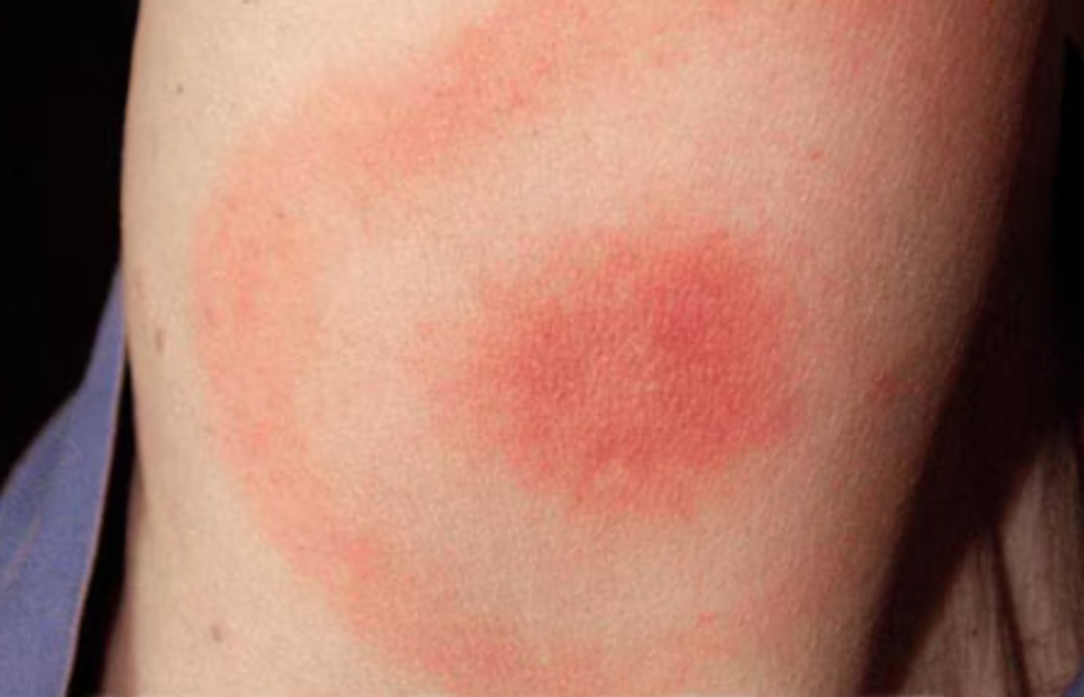 A photo of a classic Lyme Disease rash according to the U.S. Center for Disease Control. Often called an bulls-eye rash, it is a
circular, expanding rash with target-like appearance.