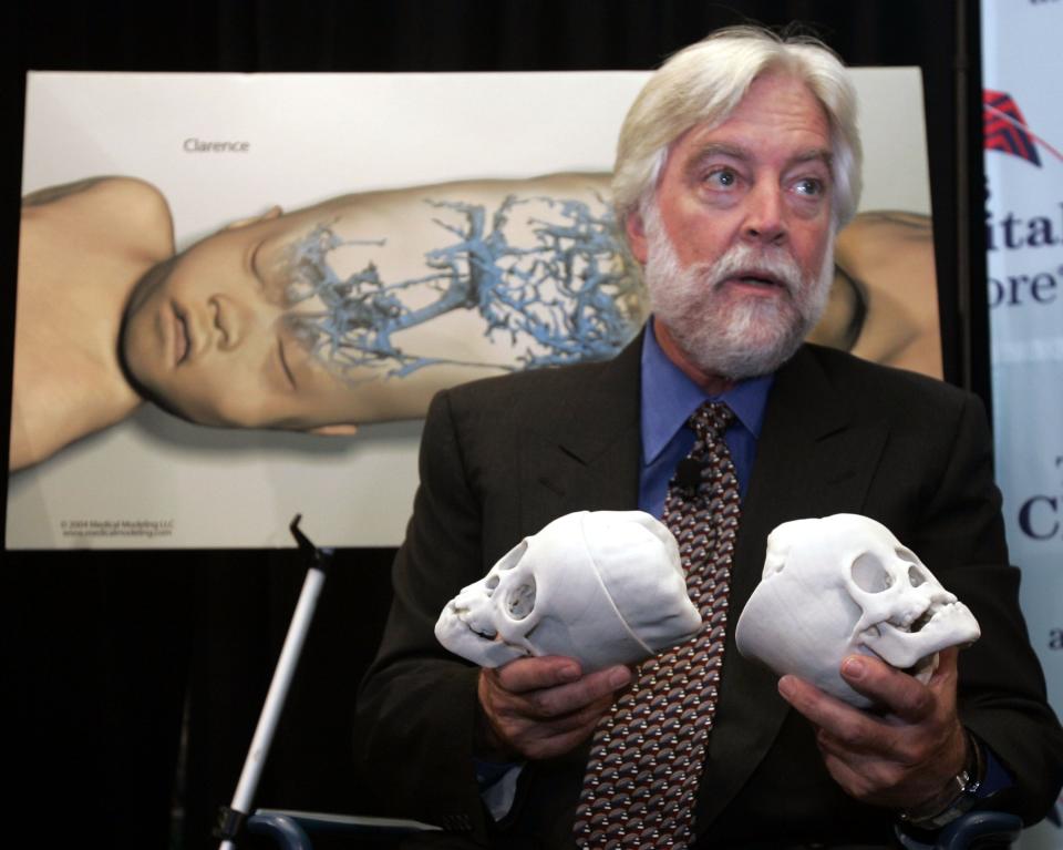 Dr. James Goodrich explains the surgery that separated conjoined twins Clarence and Carl Aguirre at Montefiore Medical Center in the Bronx in 2004. Goodrich died on March 30, 2020, from complications of COVID-19.